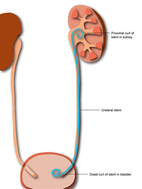 How is a ureteral stent removed? - KidneyStoners.org