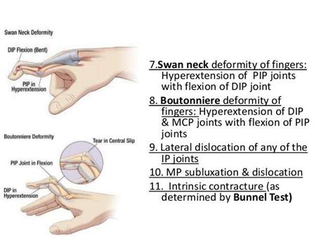 Pin by Dieu Bella on Study | Hand therapy, Rheumatoid arthritis, Arthritis