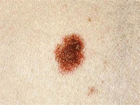 Atypical Nevus or Atypical Mole Causes & Treatment NYC