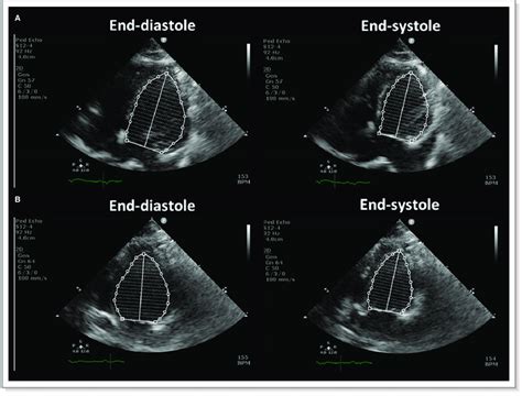 The calculation of left ventricular ejection fraction. Left ventricular... | Download Scientific ...