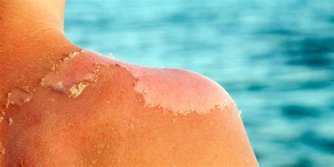 Sunburn Peeling - Why Sunburned Skin Peels & How to Stop It