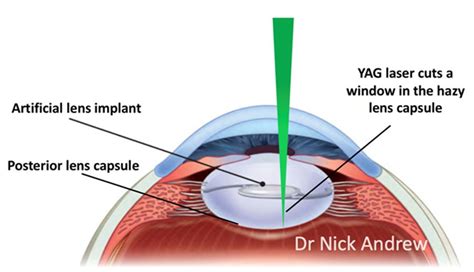 Posterior Capsule Opacification | Sight Specialists Gold Coast