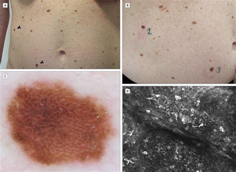 BRAF Melanomas | Dermatology | JAMA Dermatology | The JAMA Network