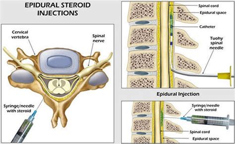 Cervical Epidural Steroid Injection NYC | Neck Pain Relief Manhattan