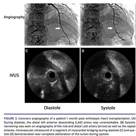 Myocardial Bridging: An Up-to-Date Review | Journal of Invasive ...