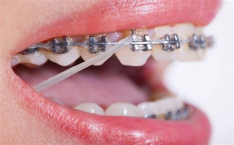 Insights on Orthodontic Treatment - Healthy B Daily