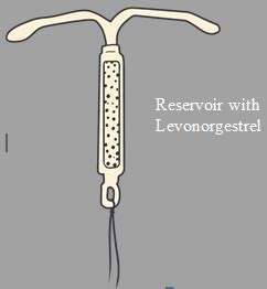 Which of the following is hormone releasing IUD?