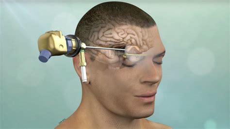 Minimally Invasive Brain Surgery | Keyhole Craniotomy | Pacific Brain Tumor Center