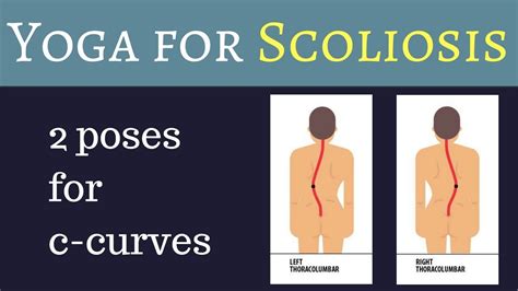 Lumbar Scoliosis Workout | EOUA Blog