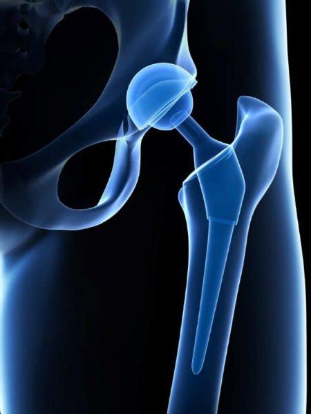 Pending Stryker Hip Replacement Product Recall - Inserra