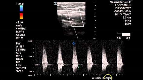 Bilateral Lower Extremity Arterial Duplex - Case Study - YouTube