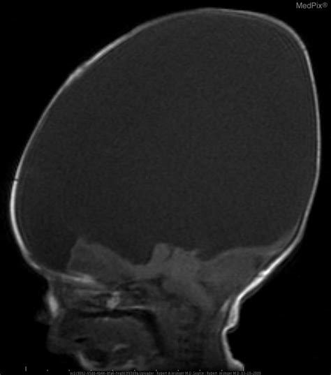 Hydranencephaly Mri