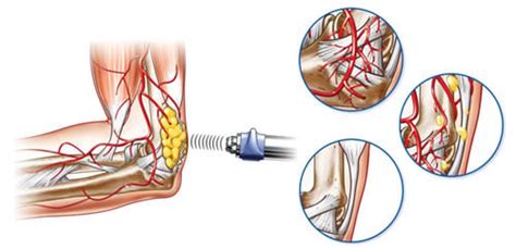 Shockwave Therapy | Three Toronto Locations