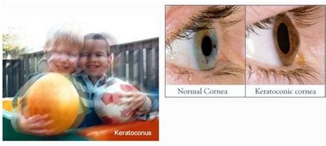 Keratoconus Treatment at best price in Ernakulam | ID: 14483594062