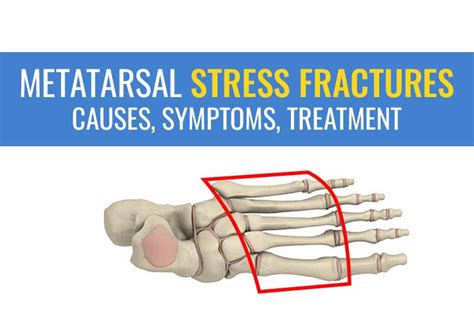 Metatarsal stress fractures – Causes, symptoms, and treatment