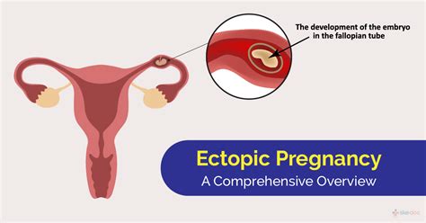 Ectopic Pregnancy | Symptoms, Causes, Treatment & Diagnosis