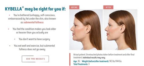 Kybella For Double Chin Dermatology Care of Charlotte | Dermatology Care of Charlotte