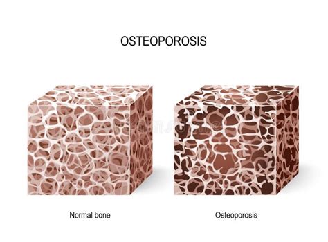 Osso Normal E Osso Com Osteoporose Ilustração do Vetor - Ilustração de ...