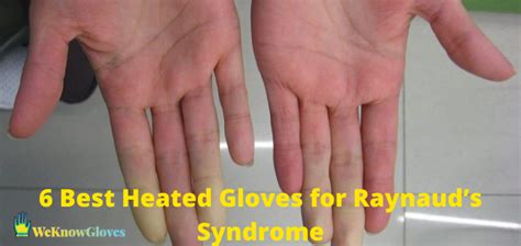 7 Best Heated Gloves for Raynaud’s Syndrome in 2024