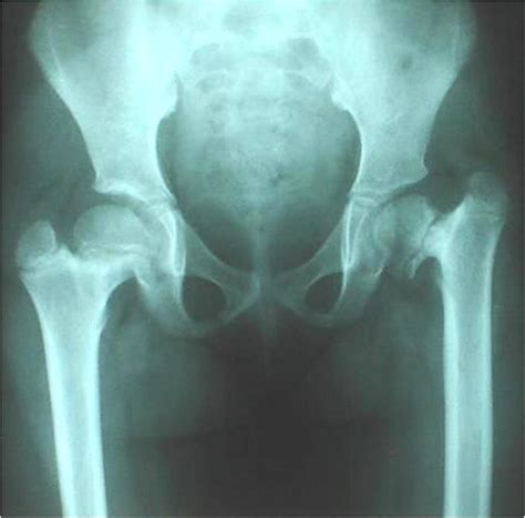 X-ray of the pelvis showing coxa vara on the left side and horizontal ...