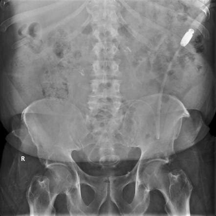 Percutaneous Radiologic Placement Of Peritoneal Dialysis Catheters | My XXX Hot Girl