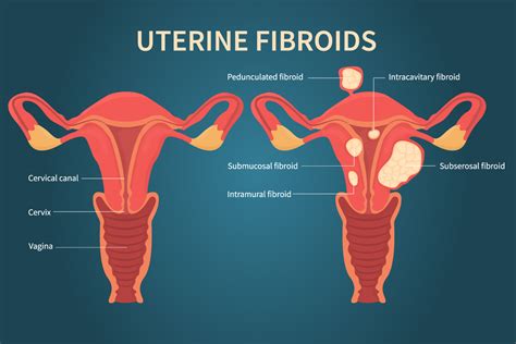 Uterine Fibroid Embolization Ufe - Mark Fibroid Care