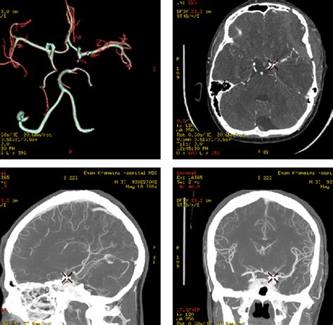 Cerebral Aneurysm Angiogram