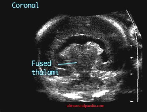 Holoprosencephaly – alobar – ULTRASOUNDPAEDIA