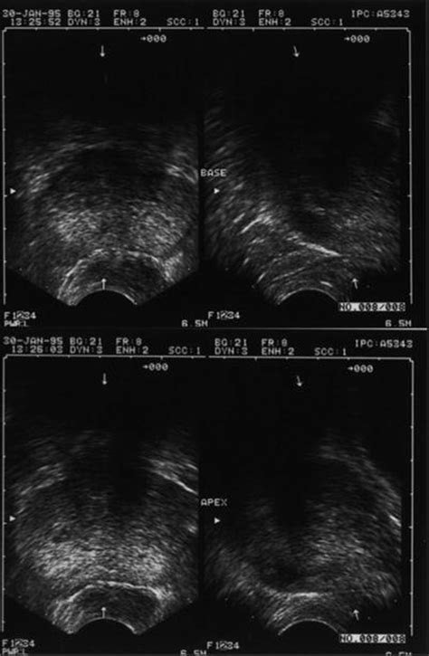 Transrectal Ultrasound of the Prostate | Radiology Key