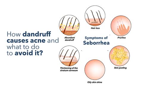 How Dandruff Causes Acne and What to Do to Avoid It - Pathkind Labs Blog