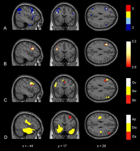 Brain region can signal early-stage Alzheimer’s and other dementias ...