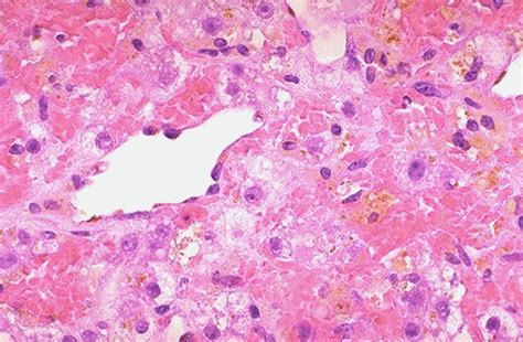 Hepatic Pathology