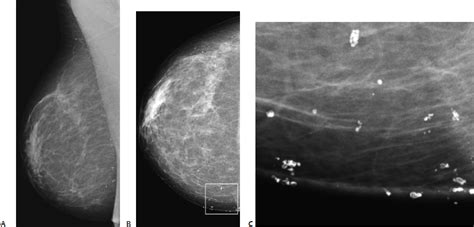 Calcifications: Small Round/Punctate | Radiology Key