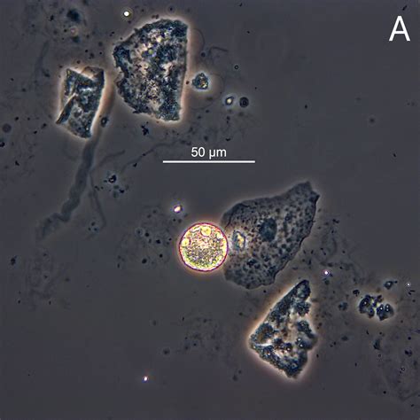 Urine Sediment of the Month: Fat Oval Bodies - Renal Fellow Network