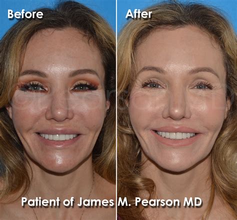 Lip Lift Photos - Before & After - Dr. James Pearson Facial Plastic Surgery