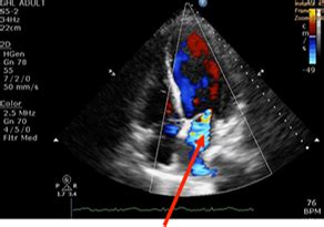 2D Echo/Doppler Study (2-Dimenstional Echocardiography/Doppler study) - Peter Yan Cardiology Clinic