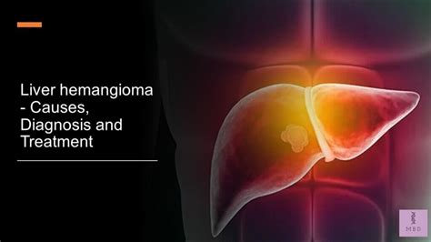 Liver hemangioma - Causes, Diagnosis and Treatment