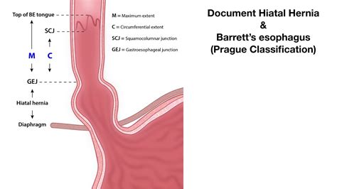 Barrett's Esophagus Who Is Barrett at Janet Johnson blog