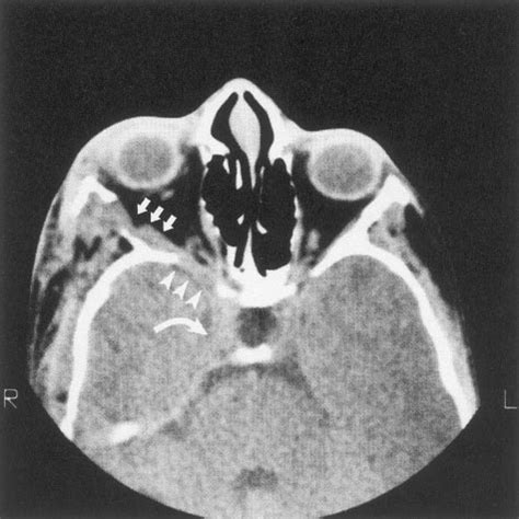 Axial CT scan shows decalcification of sphenoid bone (arrowheads)... | Download Scientific Diagram