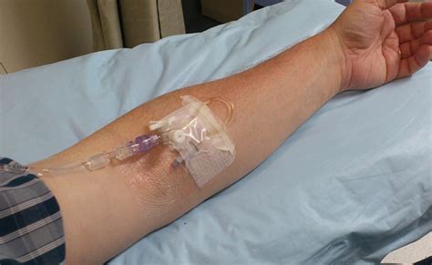 What is IVIG? - A Knowledge Archive