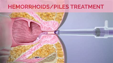 Hemorrhoids Removal Surgery I Hemorrhoid Treatment with Laser Surgery ...