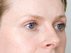 hypothyroidism eyebrows pictures - Eyebrow loss and thinning due to thyroid problems | Eyebrow ...