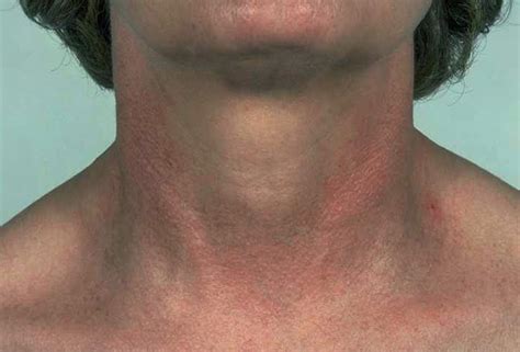 Poikiloderma of Civatte - Symptoms, Causes, Pictures, Treatment