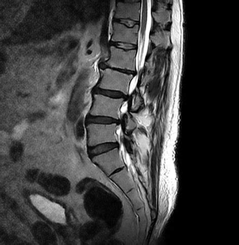 Lumbar Spine MRI scan | Medserena Open MRI