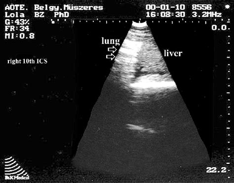 Ultrasound image from the right 10th intercostal space. Reverberation ...