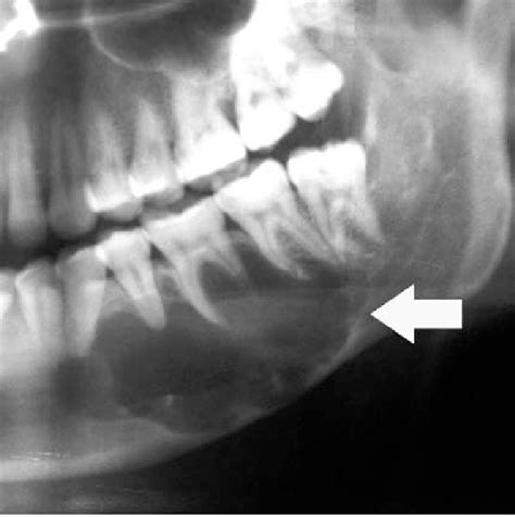 Odontogenic Keratocyst Radiology