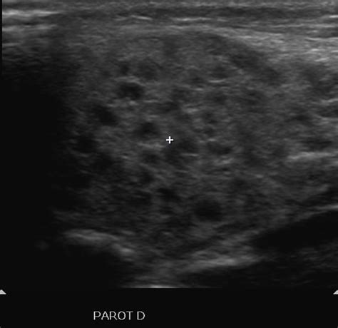 Parotitis