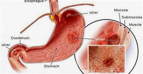 Cara Mengobati Tukak Lambung Kronis Secara Alami