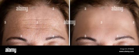 Age Anti Forehead Wrinkles Treatment Before And After Stock Photo - Alamy