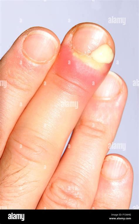 Swollen abscess hi-res stock photography and images - Alamy